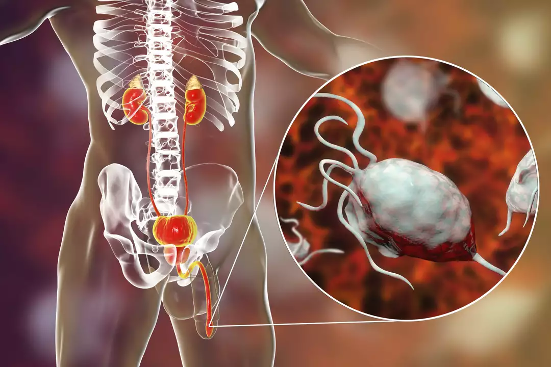 Trichomoniasis and Urethritis: What's the Connection?